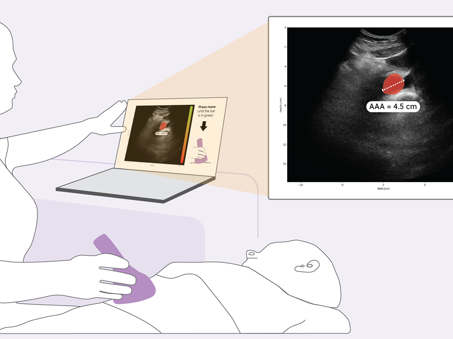 AI POCUS AAA - Artificial Intelligence guided Point-Of-Care UltraSound in remote areas on Abdominal Aortic Aneurysm