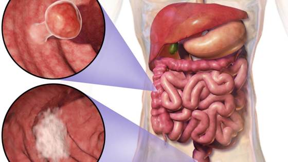 NanoEFEct – Nanoparticle-Enhanced molecular Fluorescence-Endoscopy for detection of early-stage colorectal adenocarcinomas