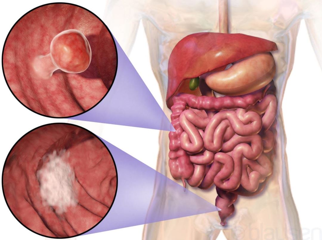 http://en.wikipedia.org/wiki/Colorectal_cancer#/media/File:Blausen_0246_ColorectalCancer.png