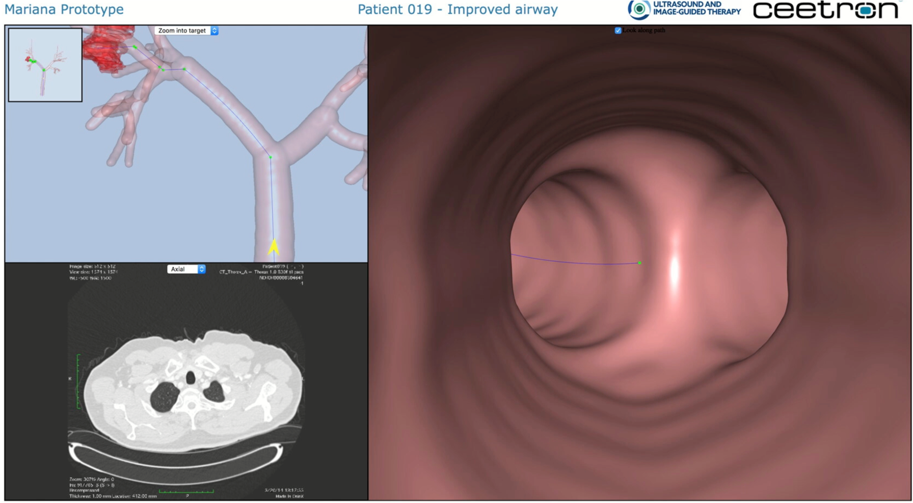 MARIANA: Image-guided catheter navigation in the outer airways