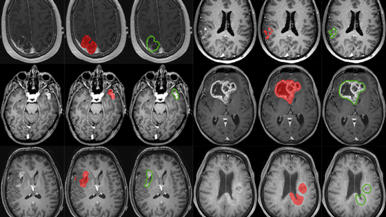 Bildeveiledet nevrokirurgi