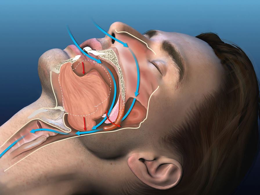 VirtuOSA - Virtual Surgery in the Upper Airways – New Solutions to Obstructive Sleep Apnea Treatment