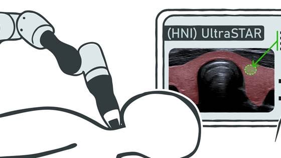 Robotassistert ultralydundersøkelse av knuter i skjoldbruskkjertelen — (HNI) UltraSTAR