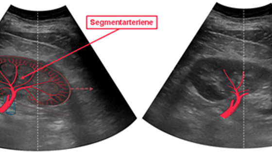 Nyreflow: Blodstrømsanalyse i nyrene med ultralyd