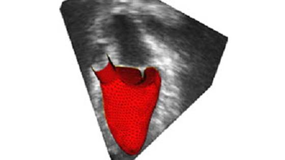 CardioSIM – Clinical proof of concept of patient-specific simulations