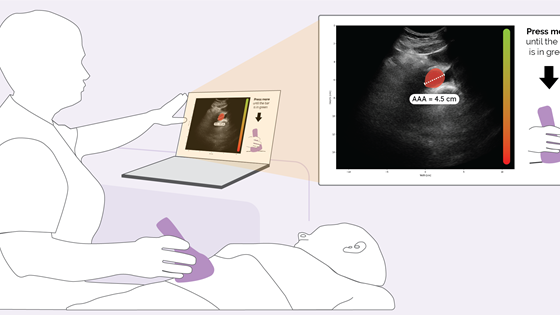 AI POCUS AAA – Kunstig intelligensveiledet ultralyd av hovedpulsåren i rurale områder