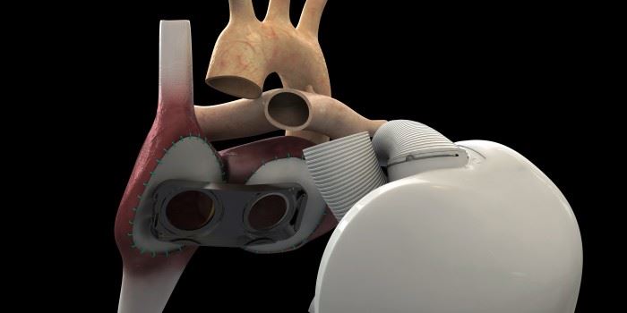 This figure shows the cardiac valves and an outline of the ventricles, membranes and cardiac valves. The three sensors are located in each ventricle chamber and in the outlet to the aorta. Ill.: Carmat.