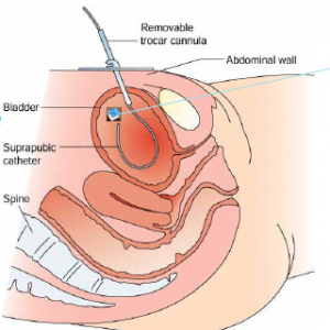  The doctors are inserting a thin needle through the skin and into the bladder. Ill: SINTEF