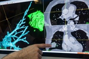 The challenge lies in getting the system to realize  that the pictures that the bronchoscope is taking inside the patient, and the CAT images that were taken earlier, refer to one and the same thing. Photo: Thor Nielsen.