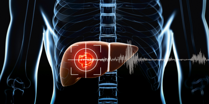 Nanocapsules containing cancer drugs can be more effective than traditional treatments. Ilustration: SINTEF/NTNU