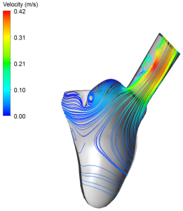 Researchers have carried out studies of both vein and valve placement, and how different valve geometries affect blood flow patterns within the heart. The illustrations demonstrate how changes in valve geometry alter blood flow as it leaves the heart and enters the aorta.  This may be of vital importance when deciding which patients should be operated on, and which surgical procedure should be selected. (Illus.: SINTEF).