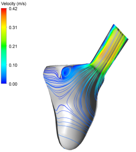 Researchers have carried out studies of both vein and valve placement, and how different valve geometries affect blood flow patterns within the heart. The illustrations demonstrate how changes in valve geometry alter blood flow as it leaves the heart and enters the aorta.  This may be of vital importance when deciding which patients should be operated on, and which surgical procedure should be selected. (Illus.: SINTEF).