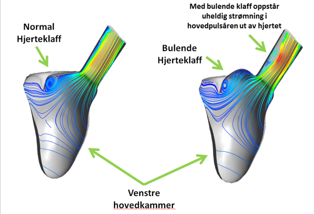 Forskerne har kjørt studier av både veneplassering, klaffeplassering og hvordan ulik form på klaff påvirker blodstrømningen i hjertet.  Illustrasjonene viser hvordan endret klaffegeometri endrer strømningen ut av hjertet og ut hovedpulsåren. Dette kan ha betydning for hvem som bør opereres og valg av opererasjon.