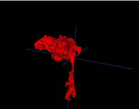 Eksempel på hvordan en 3-dimensjonell matematisk modell av luftveien bygges opp ved å skravere luftveien på røntgenbilder. Fra øverst : Snitt av pasientens hode sett ovenfra, fra siden og sett forfra. Nederst er en 3D-modell under utarbeiding. Ill.: SINTEF