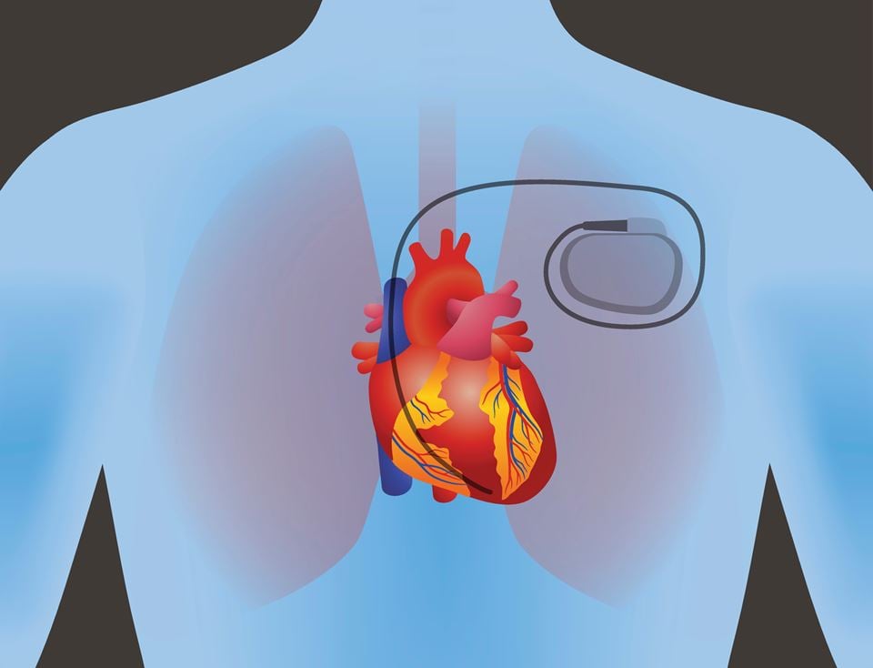 Sikkerhetsforskere i USA fant sårbarheter i utstyr for hjemmeoppfølging av pacemakerpasienter. Den amerikanske tilsynsmyndigheten FDA har gransket saken og bekreftet at sårbarhetene eksisterte, skriver artikkelforfatteren. Illustrasjon: Thinkstock