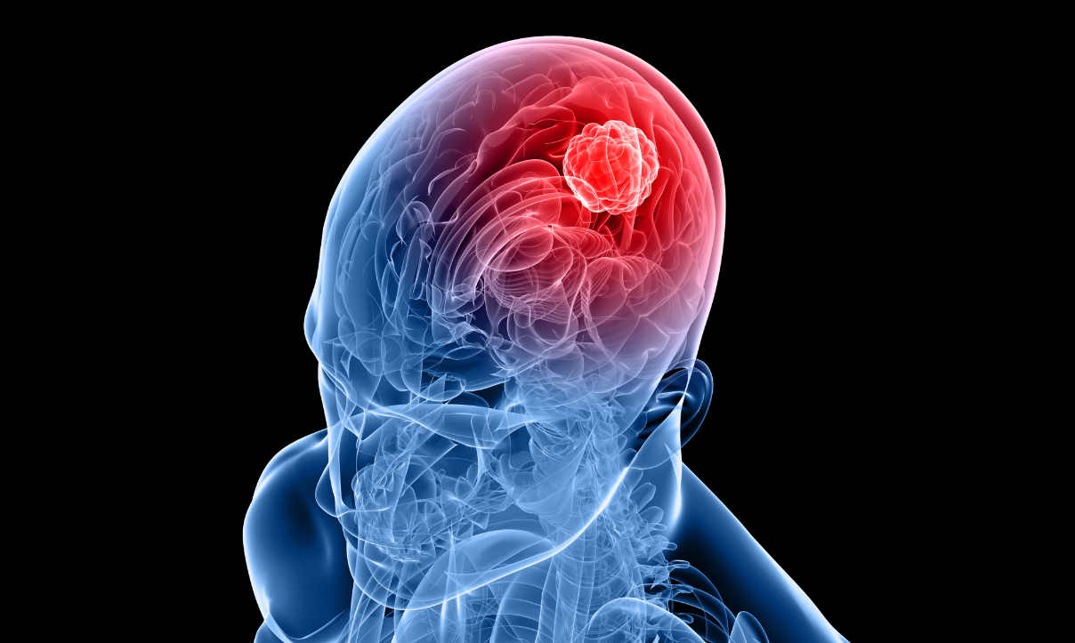 Jakten på en akustisk væske som også tåles av menneskekroppen, har gitt resultater. Det vil gi hjernekirurger verdifull hjelp når svulster skal fjernes. Illustrasjon: Thinkstock