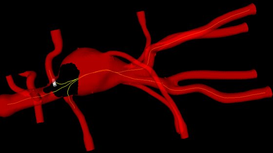 3D-teknologi forenkler operasjoner i hovedpulsåren
