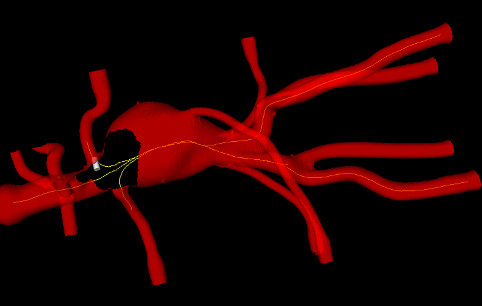 I den virtuelle 3D-modellen kan man til enhver tid se hvor instrumentene befinner seg inne i aorta basert på posisjonsdata fra sensorer integrert i instrumentene. Foto: Håvard Egge
