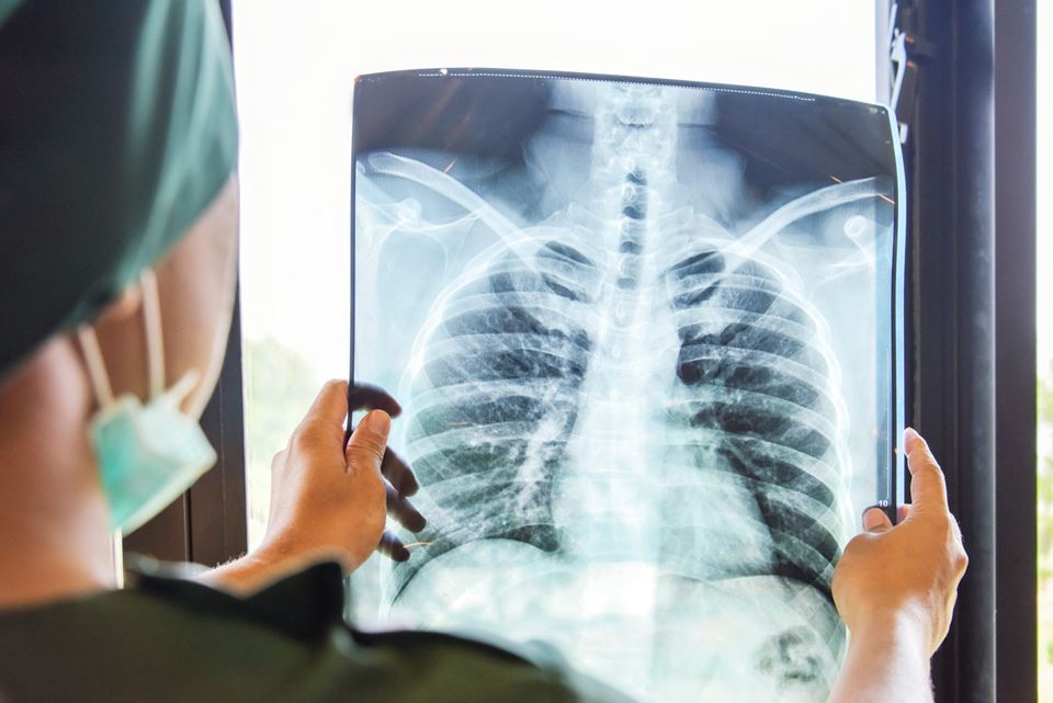 Lungekreftpasienter har dårlige prognoser. Men teknologien bak de nye kovid-vaksinene kan gi oss mer treffsikker og mindre skadelig behandling av lungekreft. Illustrasjonsfoto: Shutterstock