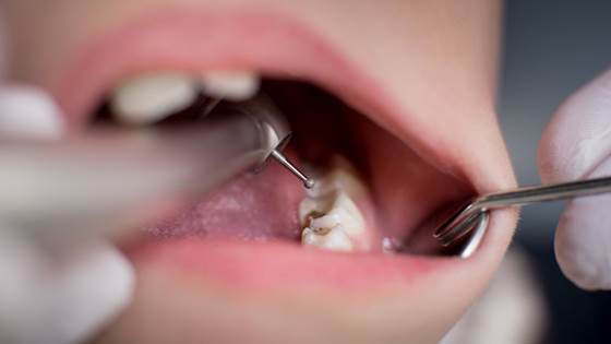 Mange tannleger sliter med å motivere unge til puss og tannstell