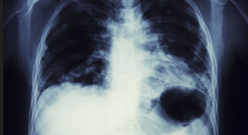 Røntgenbilde av pasient med lungekreft. Dette er den kreftformen som tar flest liv i Norge. Forskere ved SINTEF har nå utviklet en nanomedisin som viser svært lovende resultater. Foto: iStock