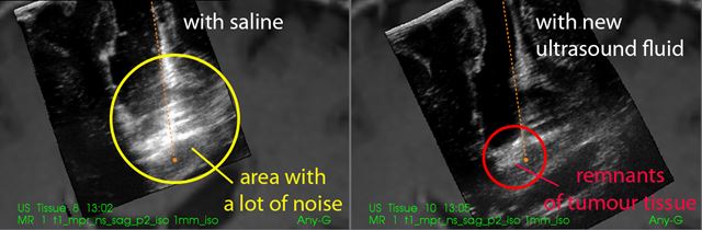 The photos show two different ultrasound images, one of which was obtained using saline solution to fill the operating channel (left), while the other was obtained using the new ultrasound fluid (right). The images were obtained at the end of the operation, when most of the tumour had been removed. At the lower edge of the operating channel, there is a lot of noise in the ultrasound image on the left. In the image on the right, the noise is gone, and you can see a light area at the bottom of the operating channel, which represents the remnants of the brain tumour and must be removed. Illustration: SINTEF 