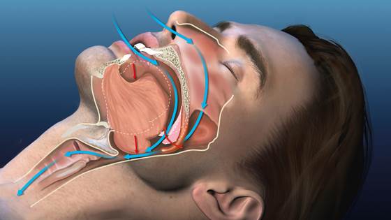 Interrupted breathing during sleep – a widespread disease with no cure