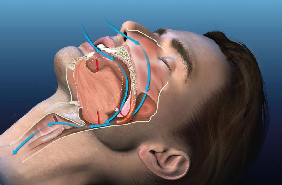 Our respiratory system is complicated and differs from person to person. This makes the treating of sleep apnea  a demanding exercise. Illustration: Shutterstock / Alex Kock