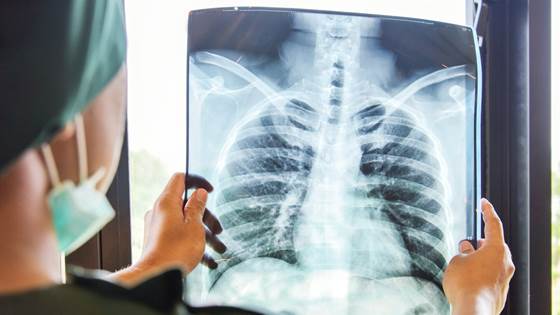 Developing a new cure for lung cancer